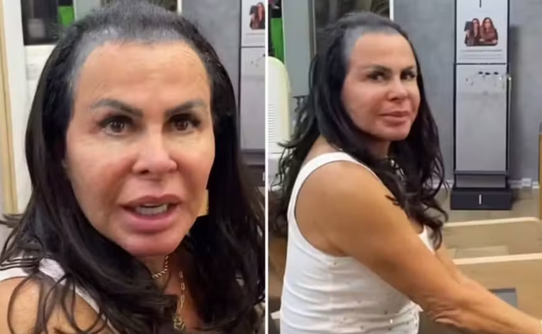 alopecia androgenética