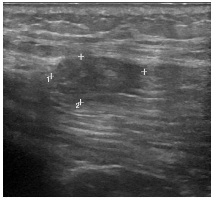 lesão de grau 2 do glúteo médio com interrupção das fibras musculares e formação do hematoma local hipoecoico